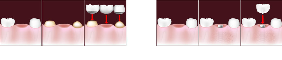 Dental Implants VS. Dental Bridges